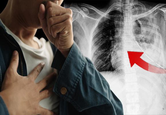 İhmale Gelmeyen Göğüs Ağrısı ve Öksürük Sonrası Riskler