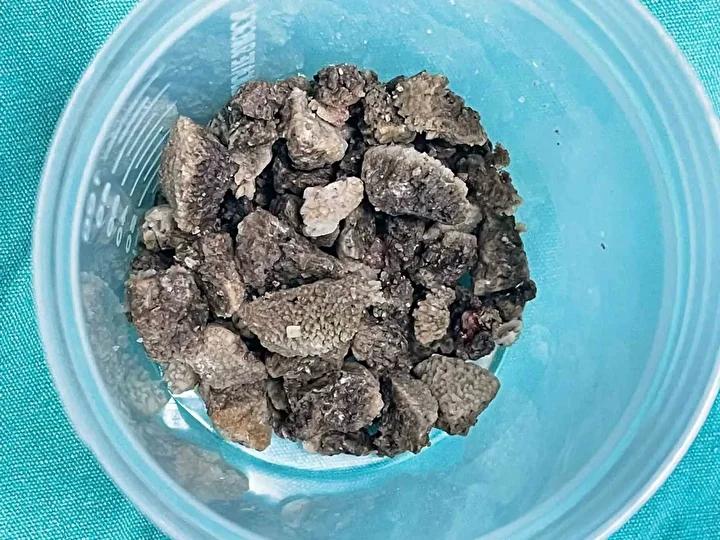 Malatya’da Büyük Böbrek Taşı Ameliyatı: Kapalı Yöntemle Başarıyla Tamamlandı