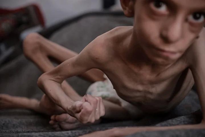 Zihinsel Engelli Navz'in Yaşadığı İnsanî Kriz ve Acil Destek İhtiyacı
