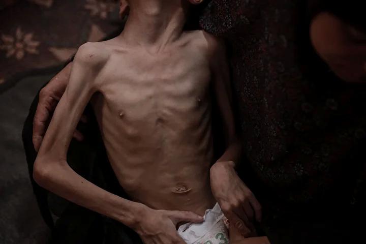 Zihinsel Engelli Navz'in Yaşadığı İnsanî Kriz ve Acil Destek İhtiyacı