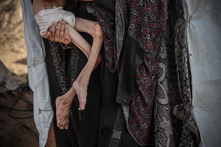 Zihinsel Engelli Navz'in Yaşadığı İnsanî Kriz ve Acil Destek İhtiyacı