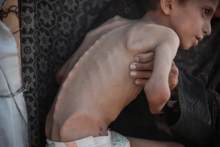 Zihinsel Engelli Navz'in Yaşadığı İnsanî Kriz ve Acil Destek İhtiyacı
