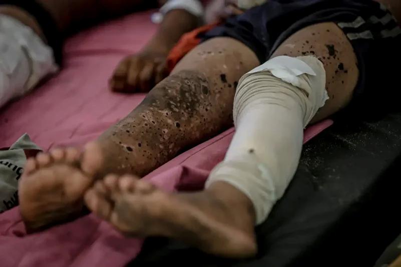 Gazze'de Çocuklara Yönelik Patlama Olayı ve Yaralanmalar