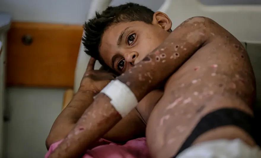 Gazze'de Çocuklara Yönelik Patlama Olayı ve Yaralanmalar