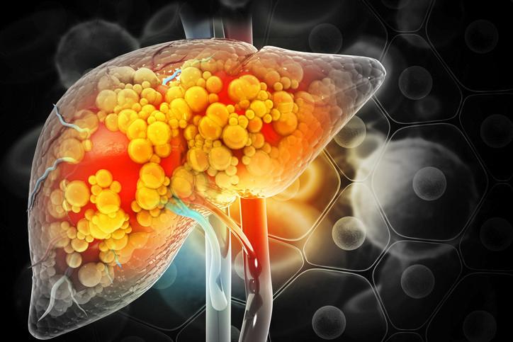 Günlük Gazlı İçecek Tüketiminin Karaciğer Sağlığına Etkileri ve Yeni Bulgular