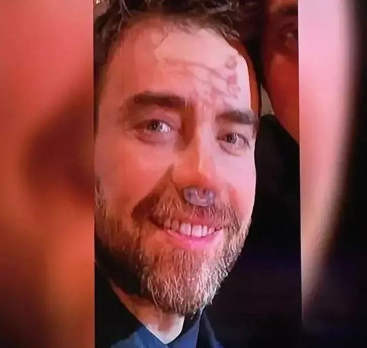 Murat Dalkılıç'ın Burun Ameliyatlarıyla Yenilenen Görüntüsü Büyülüyor