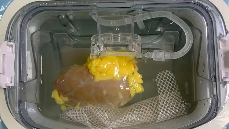 Organ Nakillerinde Devrim Niteliğinde Enzim Temelli Kan Grubu Dönüşümü 1 Organ Nakillerinde Devrim Niteliğinde Enzim Temelli Kan Grubu Dönüşümü