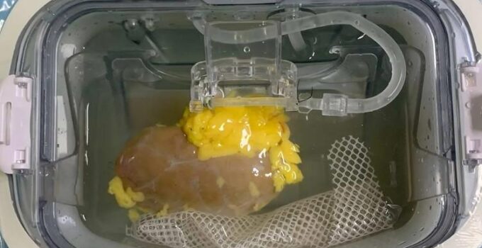 Organ Nakillerinde Devrim Niteliğinde Enzim Temelli Kan Grubu Dönüşümü