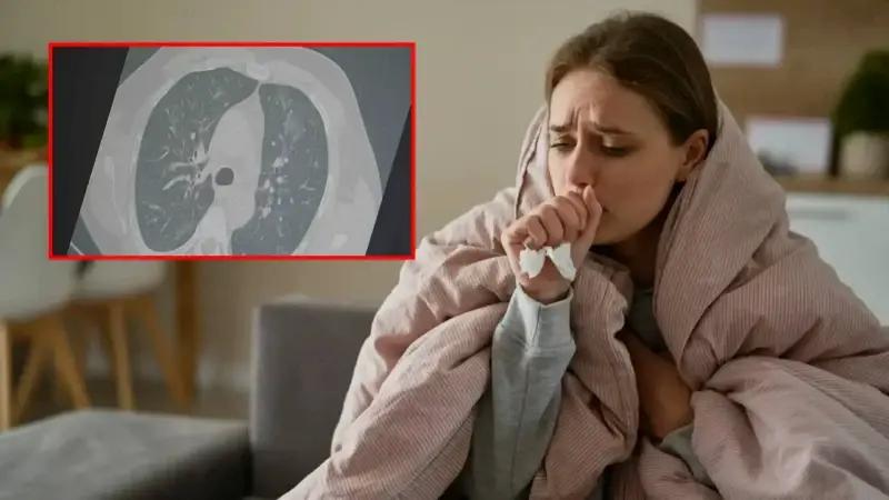 Solunum Yolu Enfeksiyonlarindaki Artis ve Guncel Varyantler Hakkinda Detaylar