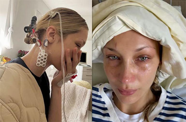 Lyme hastalığının yaygınlığı ve belirtileri
