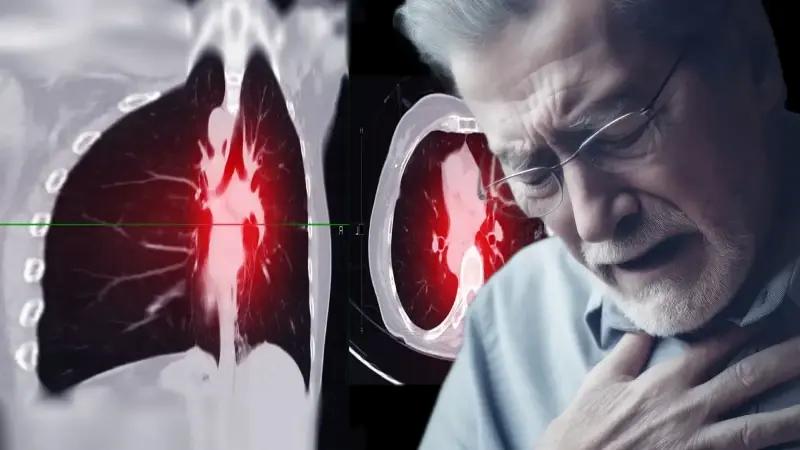 Akciger Kanseri Guncel Veriler Risk Faktorleri ve Korunma Yontemleri