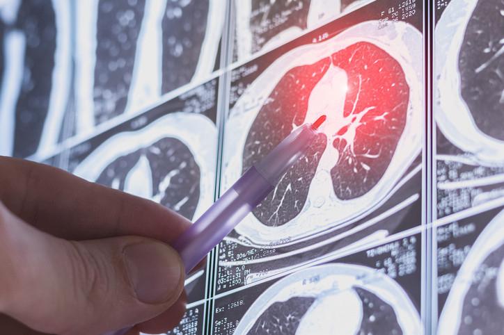 Akciger Kanseri Riskleri ve Erken Tani Yontemleri Akciger Kanseri Riskleri ve Erken Tani Yontemleri