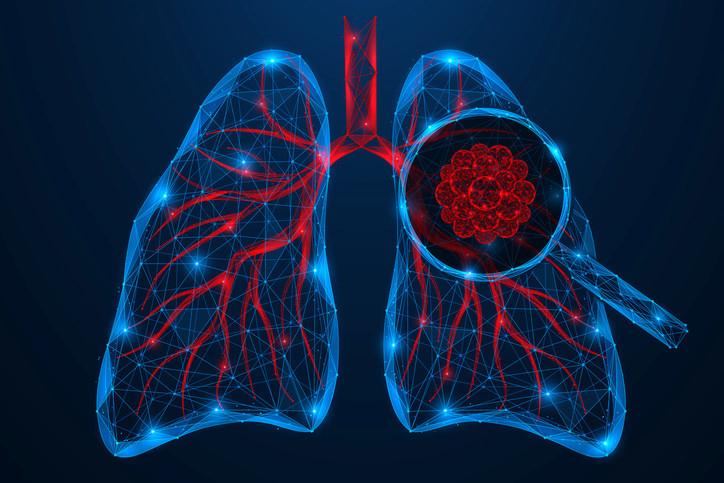 Akciger Kanseri Riskleri ve Erken Tani Yontemleri Akciger Kanseri Riskleri ve Erken Tani Yontemleri