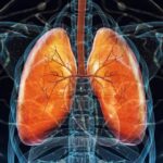 Akciger Kanseri Riskleri ve Erken Tani Yontemleri