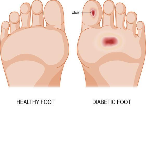 Diyabet Baglantili Uzuv Kaybini Onlemek Icin Bilmeniz Gerekenler 7 Diyabet Baglantili Uzuv Kaybini Onlemek Icin Bilmeniz Gerekenler