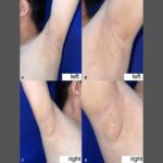 Kalbinizin Farkli Bir Bolumunde Gizli Meme Dokusu Nadiren Gorulen Bir Durumun Detaylari