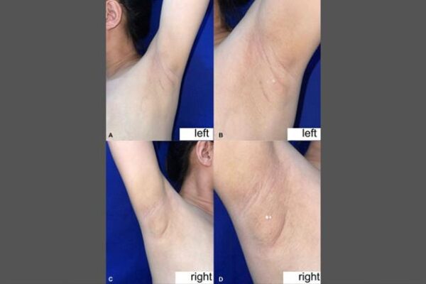 Kalbinizin Farklı Bir Bölümünde Gizli Meme Dokusu: Nadiren Görülen Bir Durumun Detayları