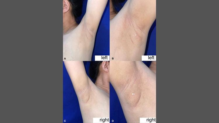 Kalbinizin Farklı Bir Bölümünde Gizli Meme Dokusu: Nadiren Görülen Bir Durumun Detayları