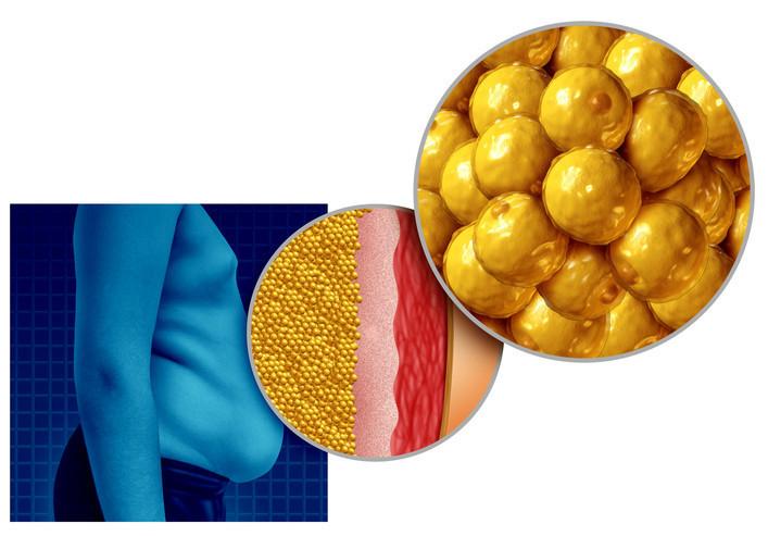 Lipödem ve Sağlıklı Yaşam İçin Yeni Yaklaşımlar