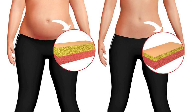 Lipödem ve Sağlıklı Yaşam İçin Yeni Yaklaşımlar