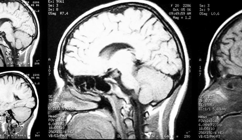 Yuz Norolojisi ve Tedavi Surecinde Yasananlar McInerny8217nin Hikayesi Yuz Norolojisi ve Tedavi Surecinde Yasananlar McInernynin Hikayesi